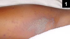 Figure 1: Examination revealed a rash that had a scaly appearance