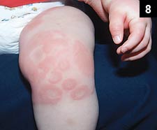 Figure 8: Urticaria has transient lesions without central necrosis but rather pale or dusky centers