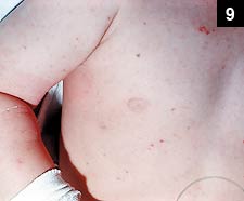 Figure 9: The rash is typically maculopapular with petechiae that starts on the distal extremities around the wrists and ankles and then rapidly spreads to the rest of the body