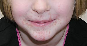 Facial rash that started as a few “bumps” several months previously, but continued to spread