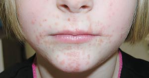 Facial rash that started as a few “bumps” several months previously, but continued to spread