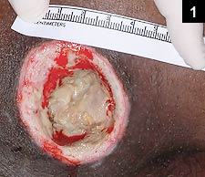 Figure 1: A pressure sore over the right ischial tuberosity