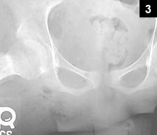 Figure 3: Plain radiographs revealed the defect with subcutaneous air noted