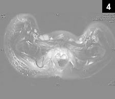 Figure 4: A MRI of the pelvis was performed, revealing that the defect extended to the ischial tuberosity