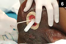 Figure 6: Use of the device involves placing a special foam into the wound