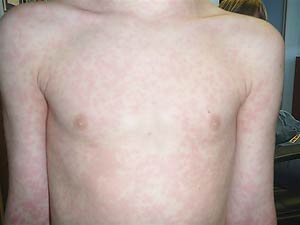 A diffuse maculopapular rash with normal skin around the initial bite mark