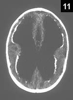 Figure 11: Early neurologic symptoms with intracranial calcifications