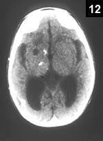 Figure 12: Congenital toxoplasmosis tends to cause the calcifications of toxo to be scattered throughout the brain