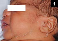 Figure 1: An 8-day-old male was referred for admission to the hospital for evaluation of jaundice with elevated liver enzymes and hepatomegaly