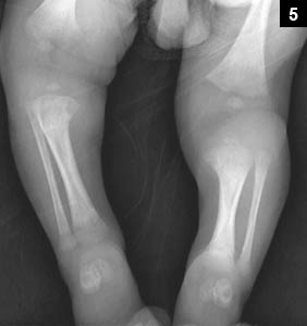 Figure 5: Radiolucent appearance of the medial aspect of the proximal tibias