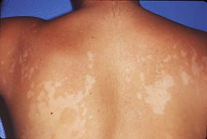 Multiple minimally scaly hypopigmented macules coalescing into patches without evidence of erythema