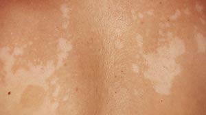 Tinea versicolor is an asymptomatic superficial fungal infection typically affecting the upper trunk and occasionally the neck and face