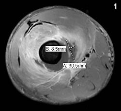 MRI with contrast of the right lower extremity revealed distal femoral osteomyelitis with a large subperiosteal abscess