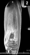 Extensive myositis with small areas of muscular abscess involving the vastus intermedius muscle