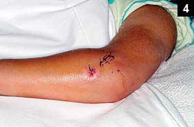 Figure 4: She made a rapid recovery after incision and drainage