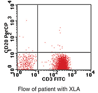 Lymphocyte phenotyping by flow cytometry for a patient with XLA