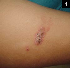 Figure 1: The patient had multiple lesions breaking out all over her body