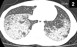 Figure 2: Lung biopsy revealed a diffuse alveolar process characterized by periodic acid-Schiff–positive material forming globular structures