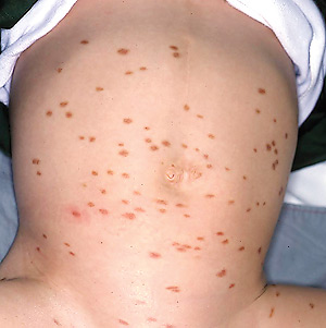 On exam, there were 10 scattered round-to-oval red-brown macules and papules dispersed over her chest, back and neck