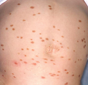 Mastocytosis is a disorder of mast cells and can develop at any age