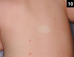 Figure 10: The usual scarlatiniform rash is a fine, papular rash on a diffuse erythematous base