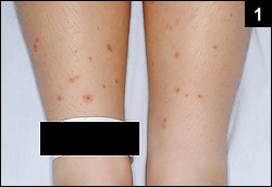 Figure 1: His fever persisted with the development of a rash on his lower extremities