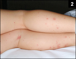 Figure 2: His fever persisted with the development of a rash on his lower extremities