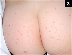 Figure 3: His fever persisted with the development of a rash on his lower extremities