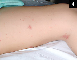 Figure 4: His fever persisted with the development of a rash on his lower extremities