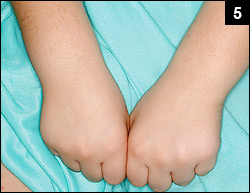 Figure 5: Painful swelling of the joints