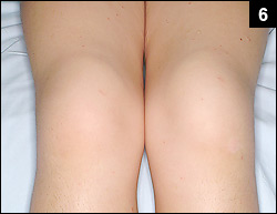 Figure 6: Painful swelling of the joints