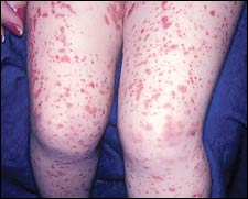 Petechial or purpuric lesions that are distributed in an acral pattern