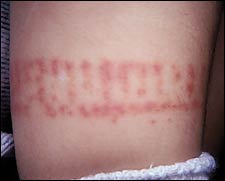 Petechial or purpuric lesions that are distributed in an acral pattern