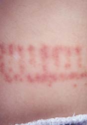 HSP is a hypersensitivity reaction that typically follows an infection