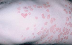 Round-to-oval papules and plaques with overlying silvery scale