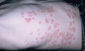 Guttate psoriasis is a form of psoriasis often seen in children and young adults