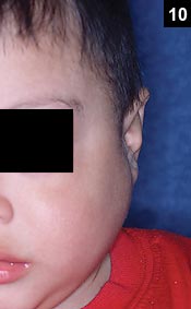 Figure 10: Parotitis results in swelling with minimal, if any overlying erythema