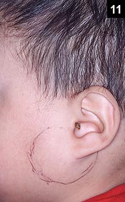 Figure 11: Parotitis results in swelling with minimal, if any overlying erythema