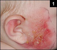 Figure 1: Obvious area of erythema on the right side of his face