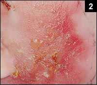 Figure 2: The rash was a bit raised with sharply defined margins