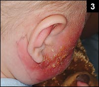 Figure 3: The rash contained some crusting material with a few vesicles of various sizes on a diffuse erythematous base