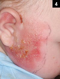 Figure 4: It is also not unusual to see vesicles and even bullae overlying the rash