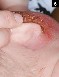 Figure 5: It is also not unusual to see vesicles and even bullae overlying the rash