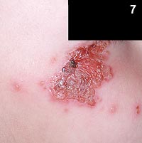 Figure 7: Cutaneous herpes simplex virus (HSV) infection would certainly have vesicles