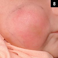 Figure 8: Haemophilus influenzae type b (Hib) would have a smooth, bright red appearance with swelling