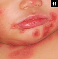 Figure 11: Erythema multiforme, a rash consisting of lesions that are round