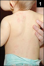 Figure 1: An evanescent pink rash