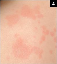 Figure 4: An evanescent pink rash