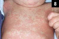 Figure 8: Kawasaki disease may present the same rash