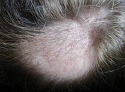 A melanocytic congenital nevus on her scalp and forehead with overlying desquamated plaques and subtle erythema